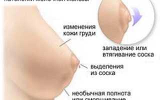 Киста молочной железы: причины, симптомы и методы лечения