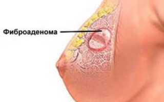 Фиброаденома молочной железы: симптомы, факторы риска, методы лечения