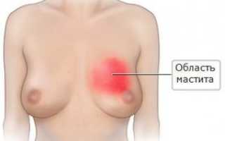 Мастит (воспаление груди) у кормящей женщины