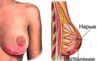 Лечение мастита: как оно должно проводиться