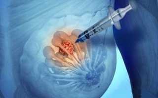 Пункция молочной железы: как проводится и где сделать