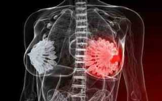 Из-за чего возникает мастопатия