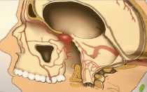 Редкое, но серьезное явление — тромбофлебит вен лица и шеи