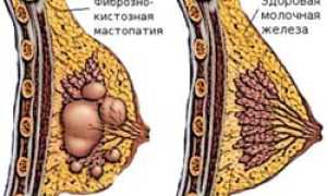 Лечение мастопатии: эффективные методы, которые помогают