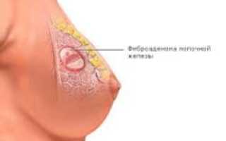 Лечение фиброаденомы молочной железы: что важно о нем знать