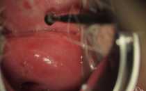 Киста влагалища: что это за новообразование и как лечить?