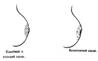 Втянутые соски: причины появления и способы коррекции