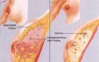 Лечение фиброзно-кистозной мастопатии: как оно должно проводиться
