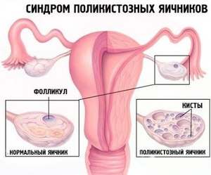 синдром поликистозных яичников