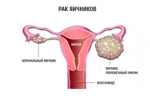 рак яичников