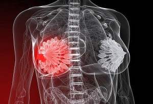 Мастопатия