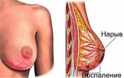 мастит схематично