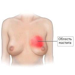 очаг мастита