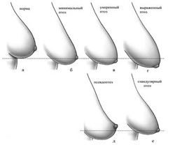 опущения груди
