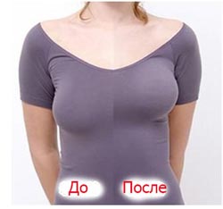 результаты подтяжки груди