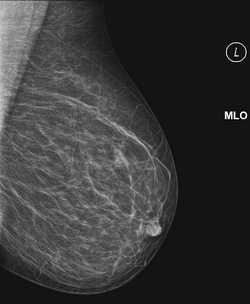 опухоль на узи