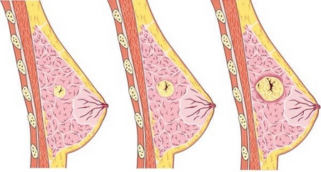 мастопатия на рисунке