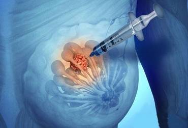 диагностика груди