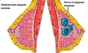 появление кист в груди