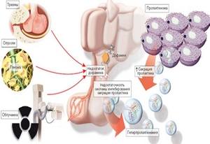 гиперпролактинемия
