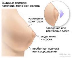 Визуальные изменения молочной железы