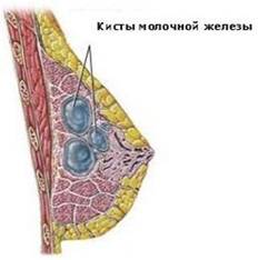 возможное расположение кист