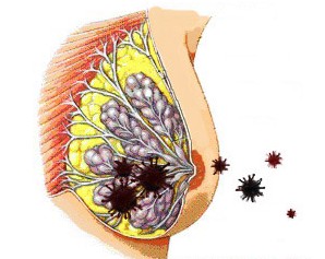 микробы при мастите попадают в молочную железу через микротрещины в соске микробы при мастите попадают в молочную железу через микротрещины в соске