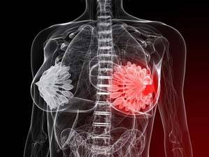 болезнь молочных желез