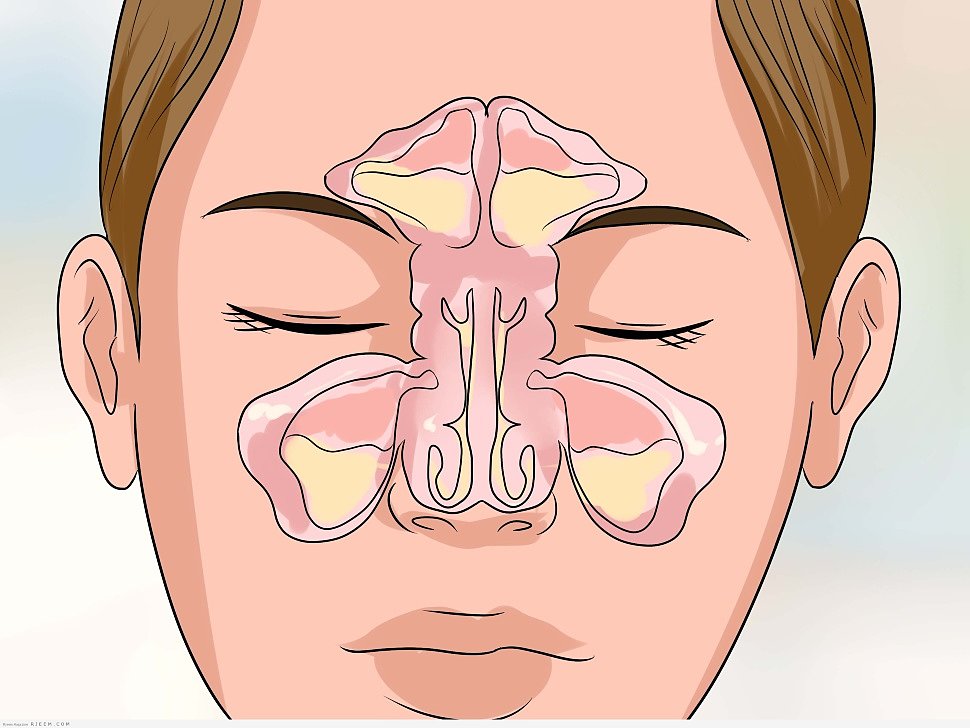 Пазухи с гноем при хроническом синусите