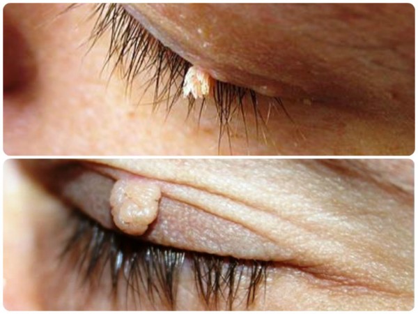 Бородавки портят внешний вид и создают дискомфорт при моргании