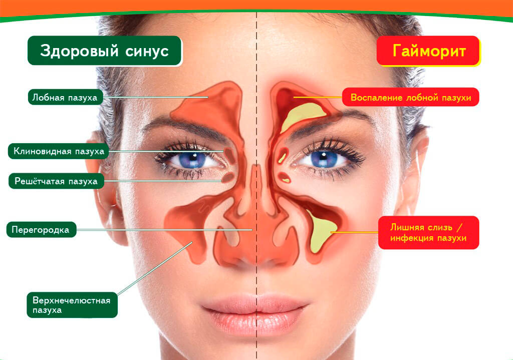 Как выглядит здоровая и воспаленная пазуха при гайморите