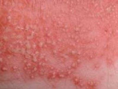 Появление пустул на на коже век при кандидозе