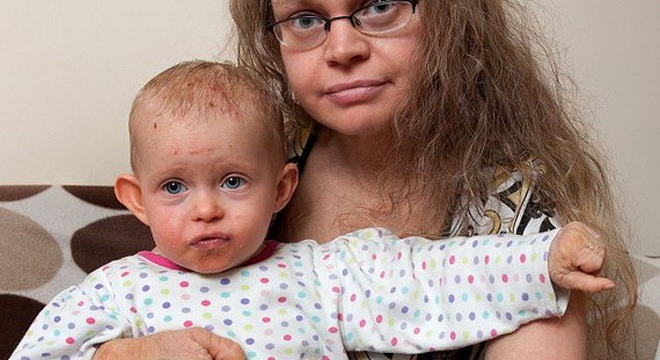 Буллезный ихтиоз имеет генетическую природу и не поддается лечению