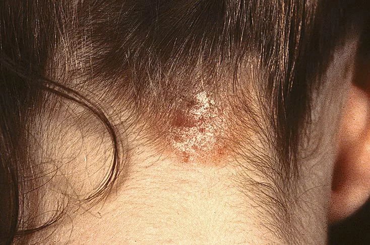 Чаще всего ограниченный нейродермит локализуется на задней поверхности шеи