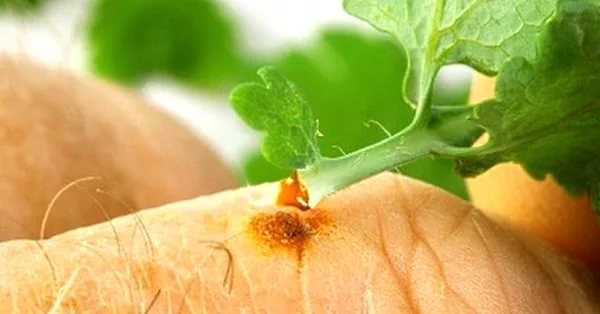 Чистотел помогает снять симптомы ихтиоза и улучшить процесс заживления кожи