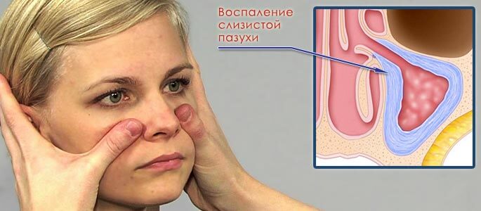 Диагностика синусита_воспаление слизистой пазухи