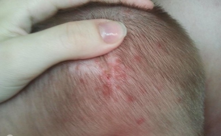 Фолликулит у ребенка протекает сложнее, чем у взрослых