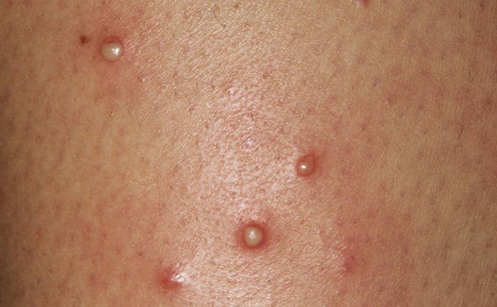 Грибковый фолликулит чаще встречается у лежачих больных, а также у мужчин в возрасте 20-45 лет.