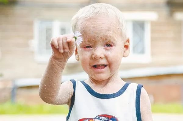 Ихтиоз является врожденным заболеванием, вызванным генетическими нарушениями