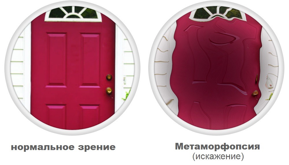 Искажение предметов при метаморфопсии