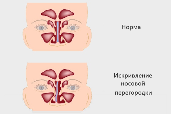 Искривление носовой перегородки и норма