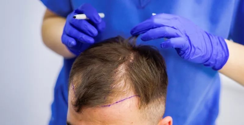 К трансплантации прибегают при необратимых изменениях волосяных фолликулов