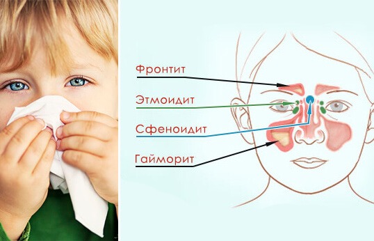 Классификация заболевани при синусите- этмоидит фронтит сфеноидит гайморит