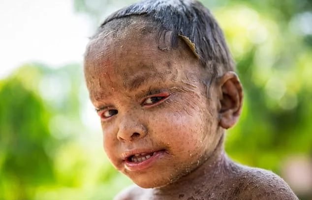 Ламеллярный ихтиоз развивается в том случае, если оба родителя являются носителями дефектного гена