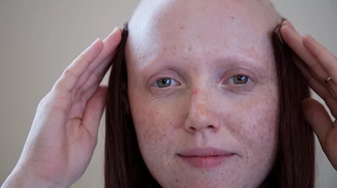 Наиболее интенсивно волосы выпадают после химиотерапии