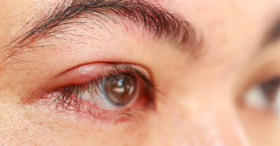 Небольшое воспаление может быстро перерасти в крупный гнойник, если вовремя не предпринять меры