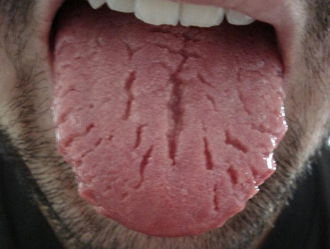 Патология имеет врожденный характер и чаще всего протекает безболезненно