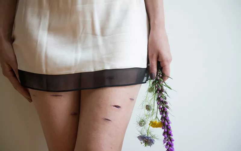 Патомимия относится к психическим нарушениям, проявляющимся в виде самоистязания