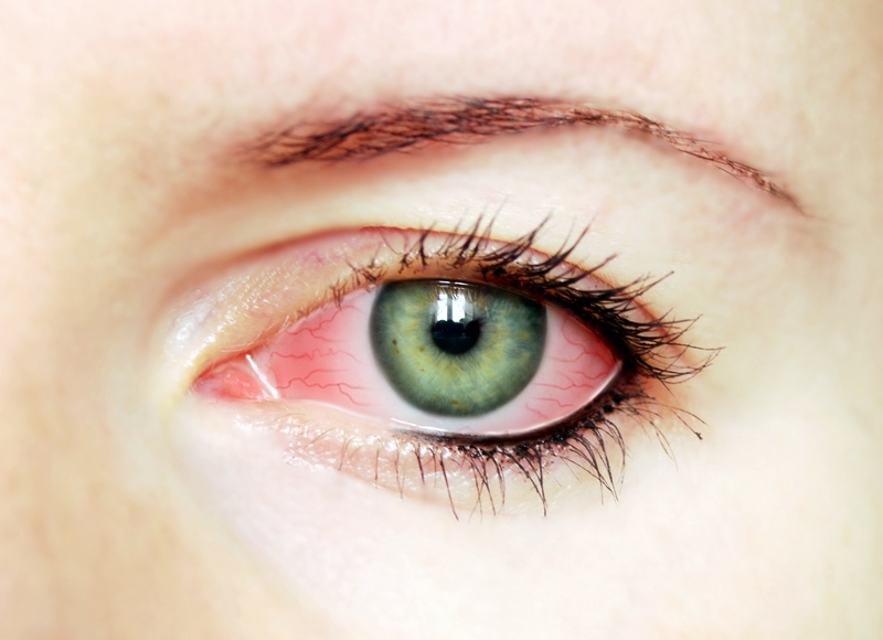 Покраснение глаз - один из признаков заболевания