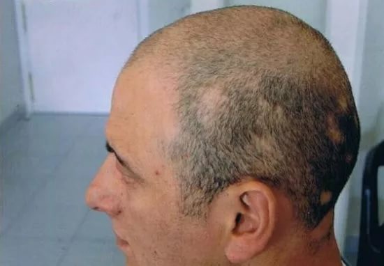 Потеря волос у мужчин часто носит наследственный характер